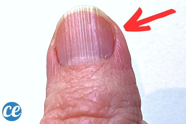 Pourquoi Mes Ongles Sont Striés ? Et Que Faire Pour y Remédier