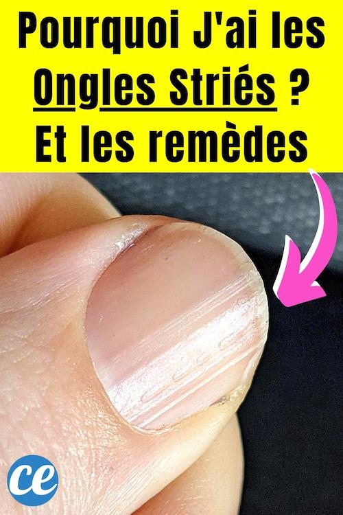 Pourquoi Mes Ongles Sont Striés ? Et Que Faire Pour y Remédier