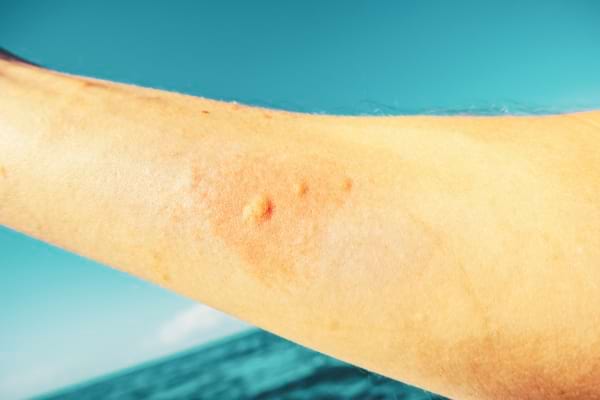 Pimples on an arm caused by the anthrax fly