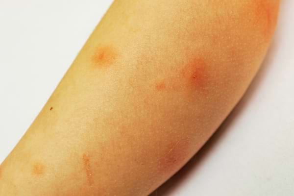 an arm stung several times by an anthrax fly