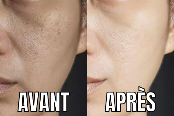 Une photo de pores dilatés avant et après un soin visage radical.