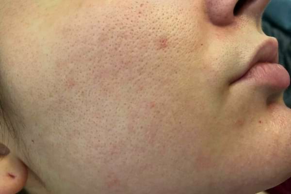 Les pores dilatés sur le visage ont plusieurs causes, y compris une mauvaise routine de beauté.