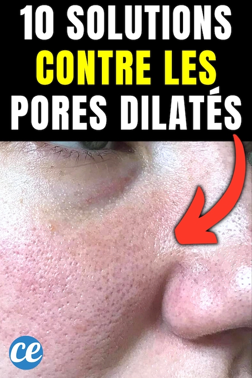 Pores Dilatés 10 Solutions Radicales Pour Les Resserrer Au Naturel