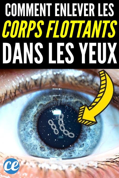 Pourquoi voit-on des corps flottants dans les yeux ? Et comment s'en débarrasser ?