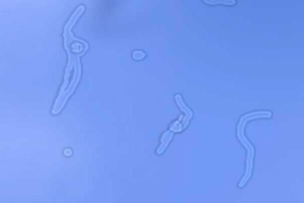 Des corps flottants dans les yeux, aussi appellés myodésopsies.