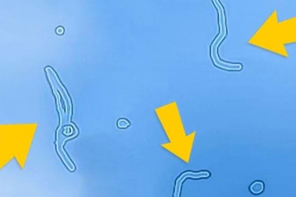 Les corps flottants apparaissent souvent après 40 ans et chez les myopes.