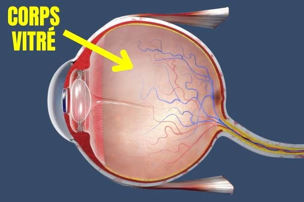 Les corps flottants se forment dans le corps vitré de l'œil.