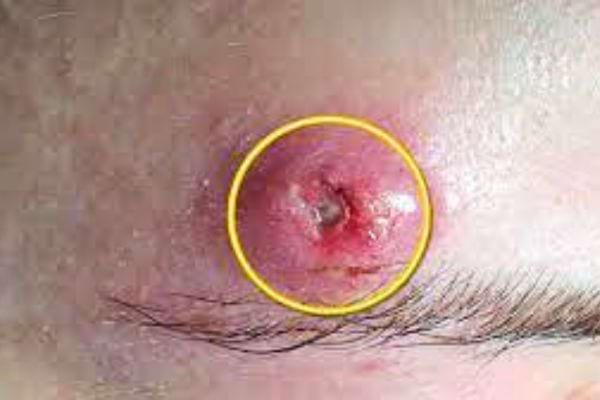 Les furoncles sont très contagieux.