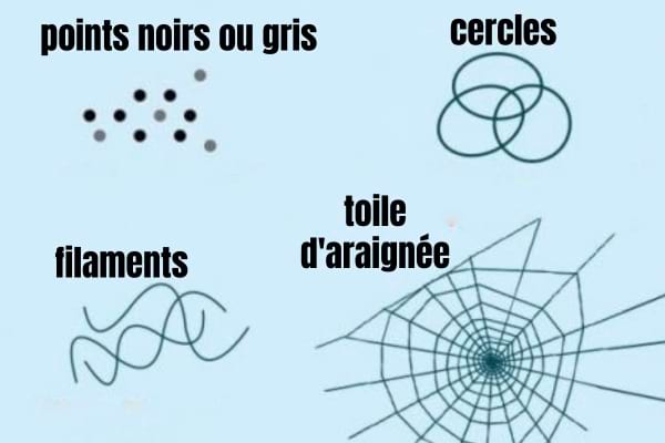 Les 4 types de corps flottants dans les yeux.