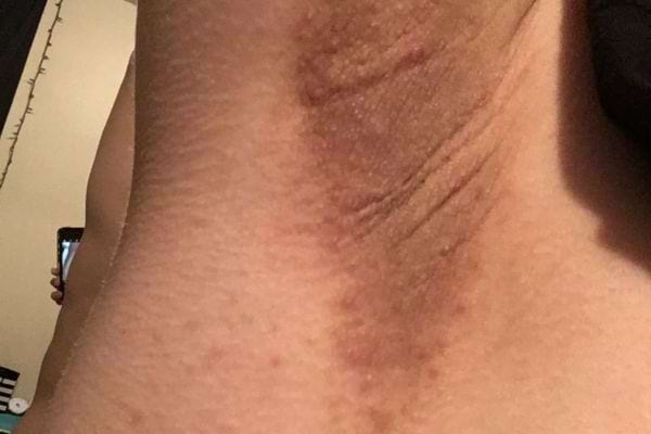 Une personne ayant des tâches sur ses aisselles 