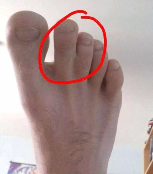 Un pied blanc avec des orteils collés