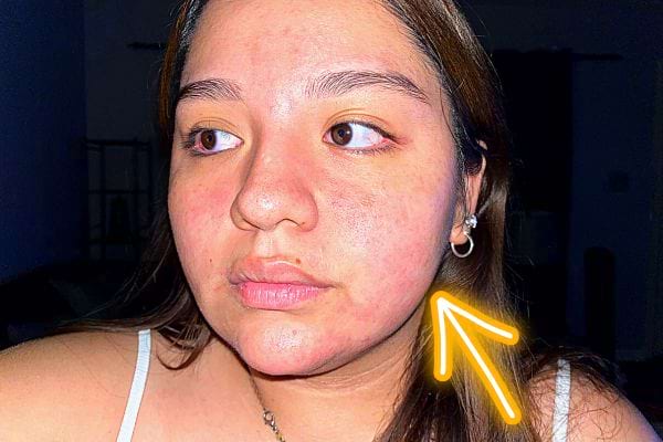 Une femme ayant un visage avec des éruptions cutanées