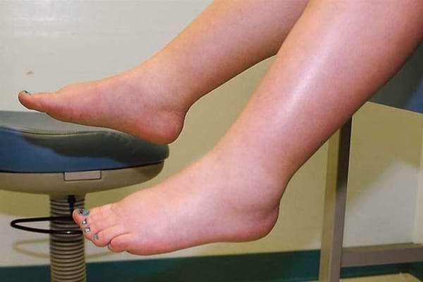 Des jambes qui font de la rétention d'eau