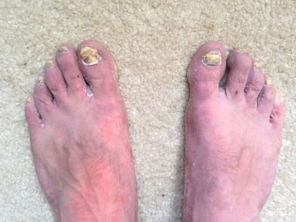 Des pieds avec des ongles abîmés