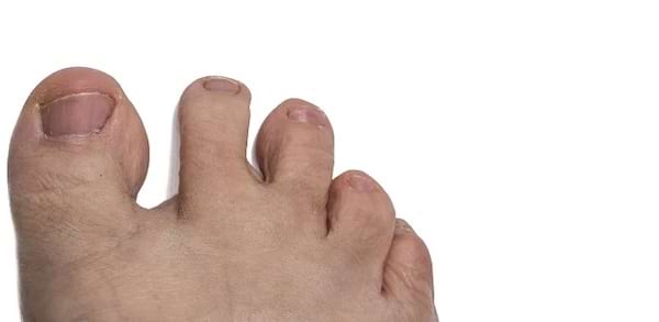 Un pied avec des orteils courts