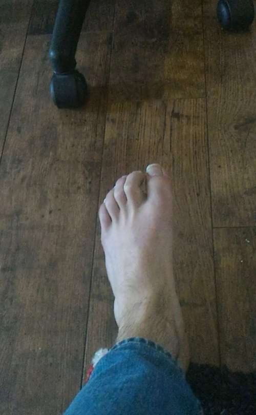 Un pied avec des orteils pliés
