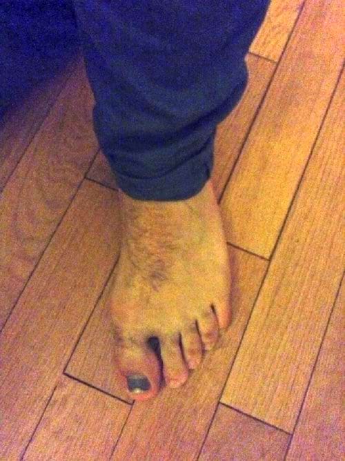 Un pied avec un ongle noir
