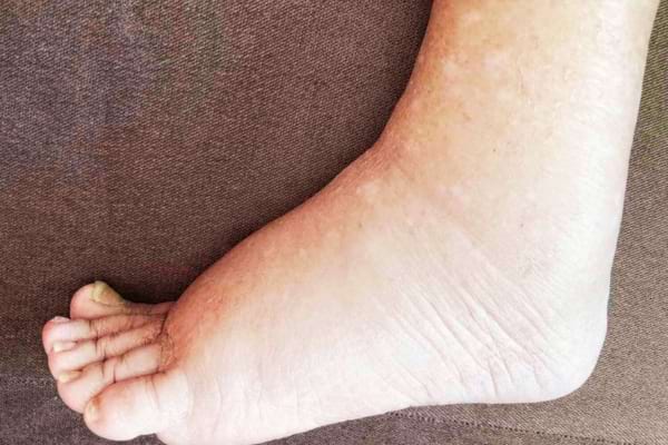 Un pied qui fait de la rétention d'eau