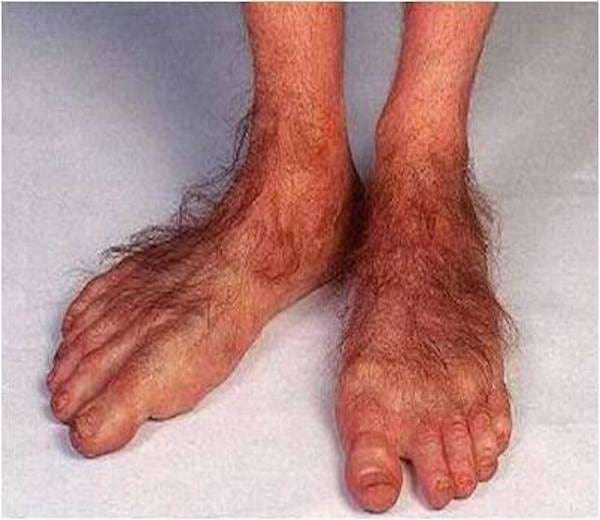 Des pieds extrêmement poilus