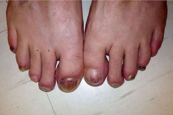Des pieds avec des ongles noirs