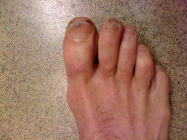 Un pied avec des ongles noirs