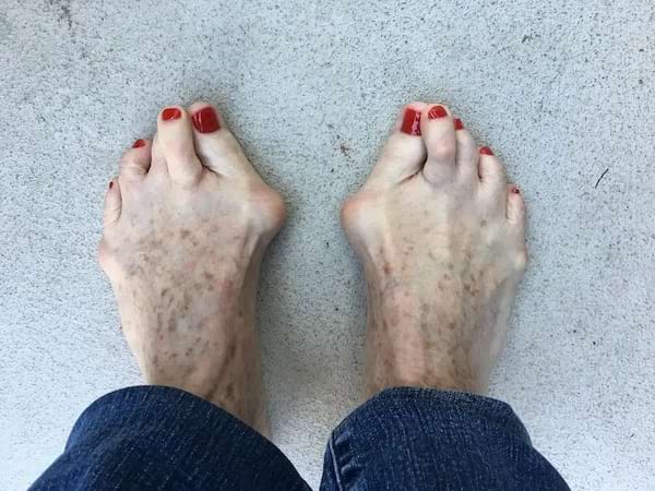 Des pieds bossus sur les côtés avec du vernis rouge