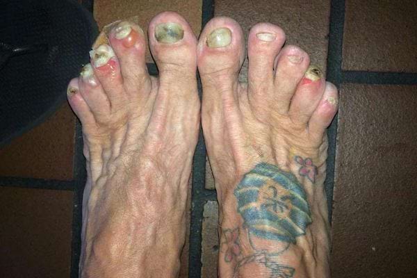 Des pieds tatoués avec des orteils abîmés et des cloques