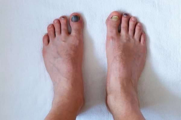 Des pieds avec des ongles noirs