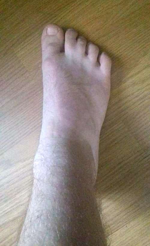 Un pied blanc avec des orteils collés