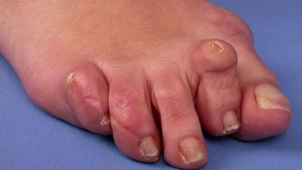 Un pied avec des orteils crochus