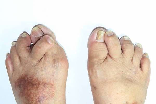 Des pieds avec des orteils croisés