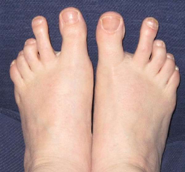 Des pieds blancs avec des orteils écartés
