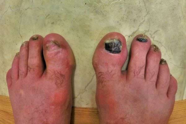 Des pieds avec des orteils noirs