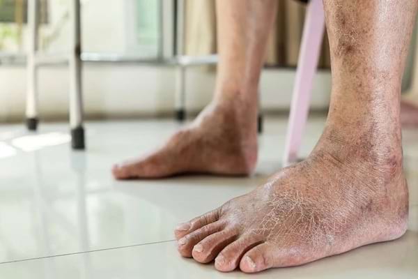 Des pieds avec la peau sèche
