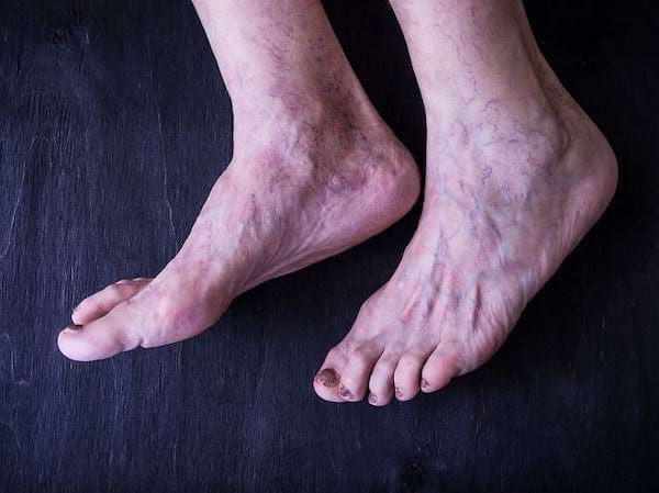 Des pieds avec de la varice