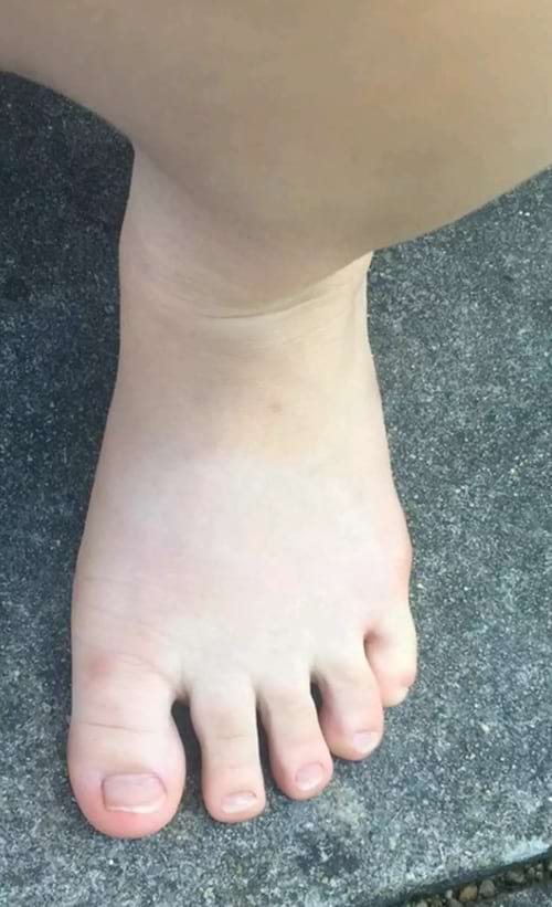 Un pied blanc normal
