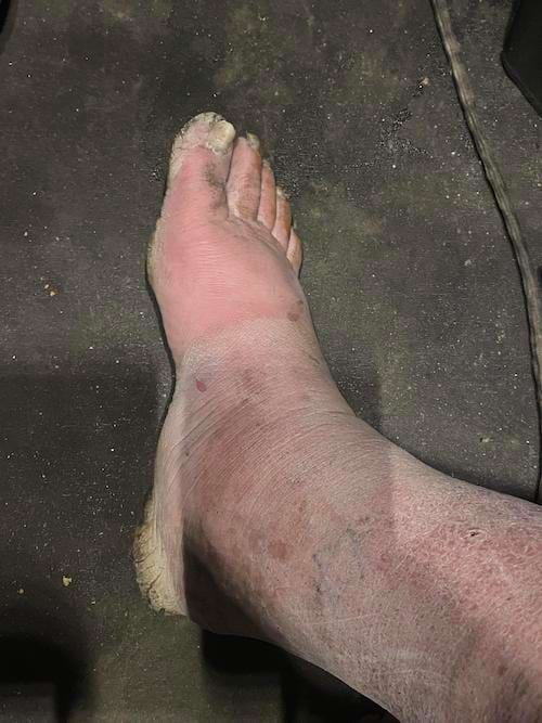 Un pied épais complètement sale