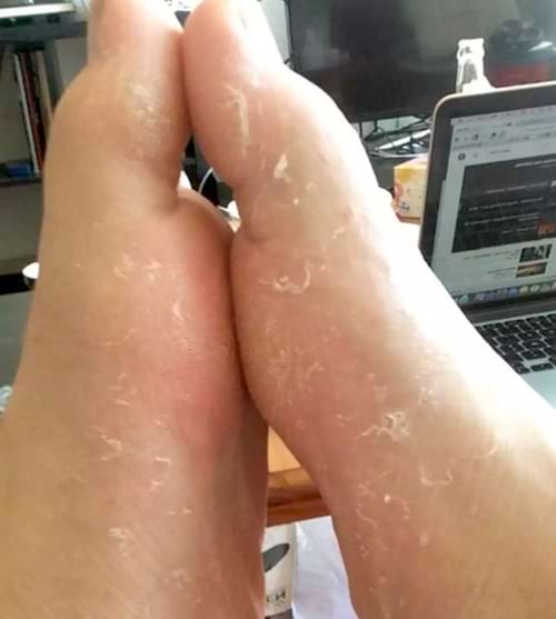 Des pieds avec de la peau sèche