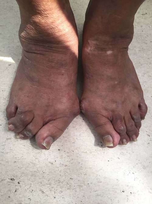 Des pieds foncés qui vont sur les côtés