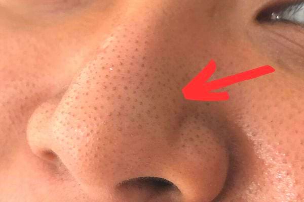 Une femme ayant des points noirs sur son nez 