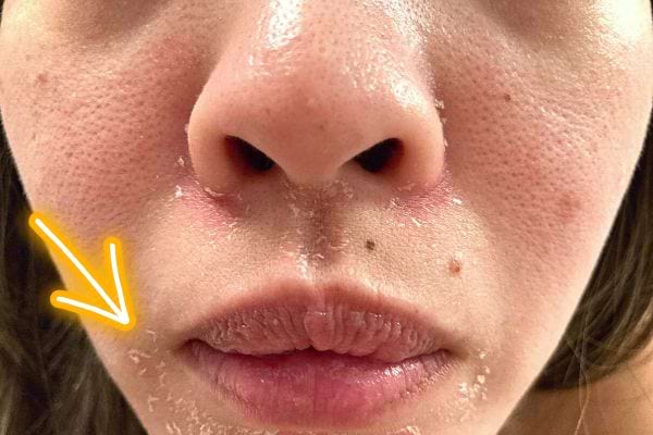 Une femme avec de la sècheresse sur son visage