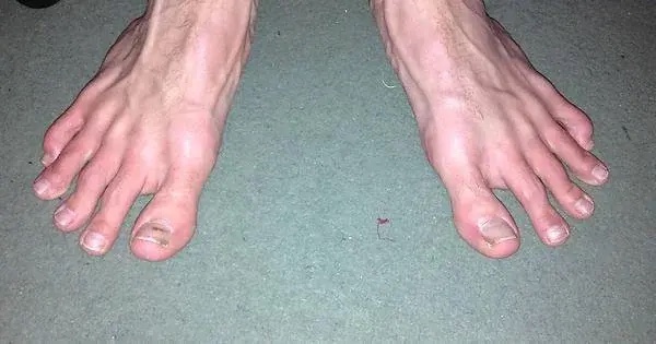 Top 63 Des Pieds Les Plus Moches Du Monde top-63-des-pieds-les-plus-moches-du-monde