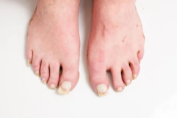 Top 63 Des Pieds Les Plus Moches Du Monde top-63-des-pieds-les-plus-moches-du-monde