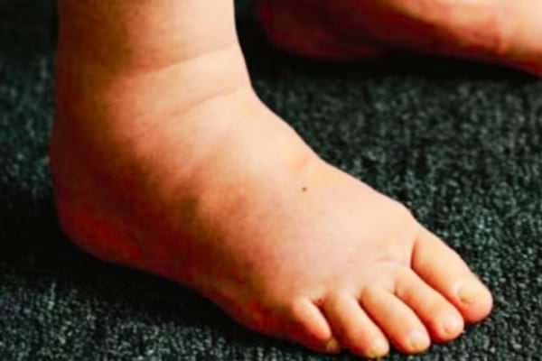 Un pied gonflé à cause de la rétention d'eau