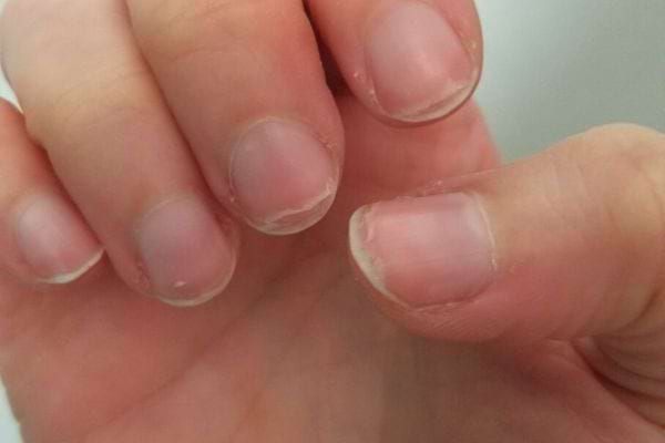 Une main avec les doigts pliés et des ongles abîmés
