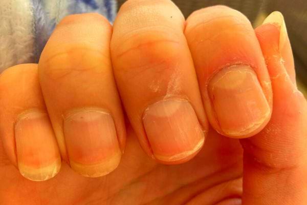 Ongles Qui Se Dédoublent : Causes et Remèdes.