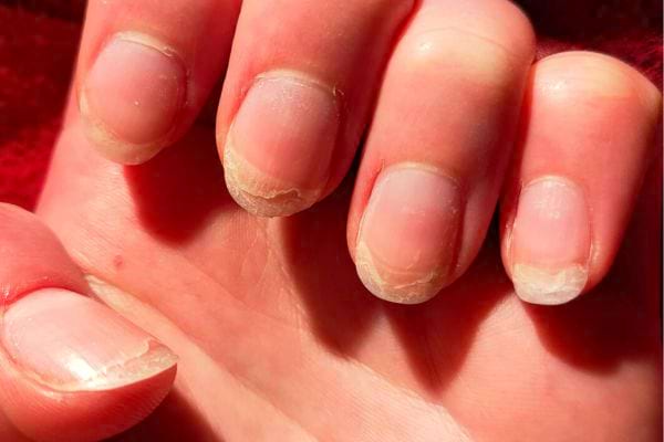 Une main avec les doigts pliés et des ongles abîmés