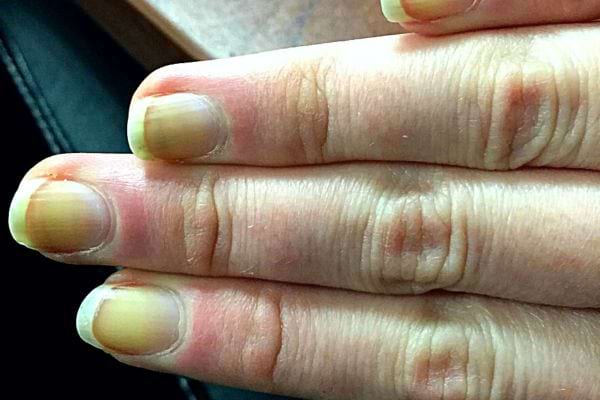 Une personne ayant des ongles jaunes 