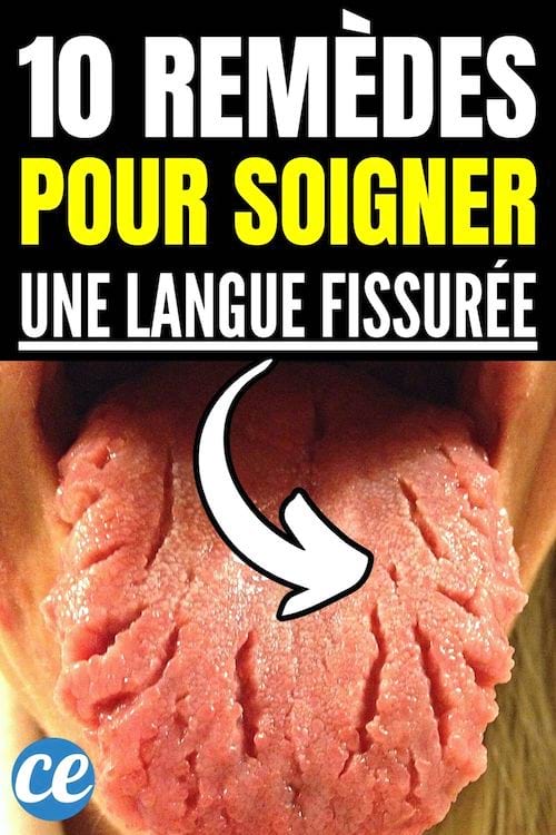 10 remèdes pour soigner une langue fissurée