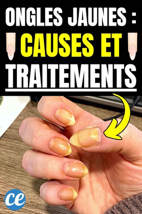 Ongle Jaune Quels Causes et Traitements Efficaces